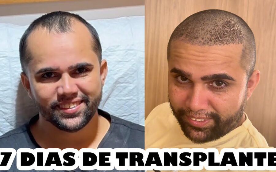 Marcos Taylor, 11 anos, sorrindo saudável dois anos após transplante de rim doado por enfermeira no Hospital das Clínicas de Ribeirão Preto