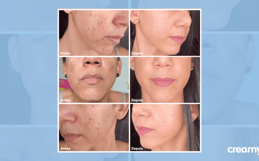 Kit Creamy com 4 produtos essenciais de skincare dermocosmético brasileiro