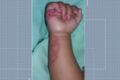 Hematoma roxo no rosto de bebê de 2 anos após ficar em creche municipal de Praia Grande