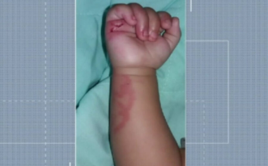 Hematoma roxo no rosto de bebê de 2 anos após ficar em creche municipal de Praia Grande