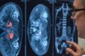 Exame de imagem renal mostrando detecção de carcinoma de células claras com nova técnica de medicina nuclear