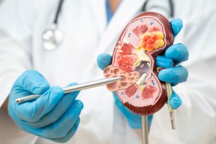 Exame PET/CT mostrando lesões de carcinoma renal de células claras com alta precisão diagnóstica