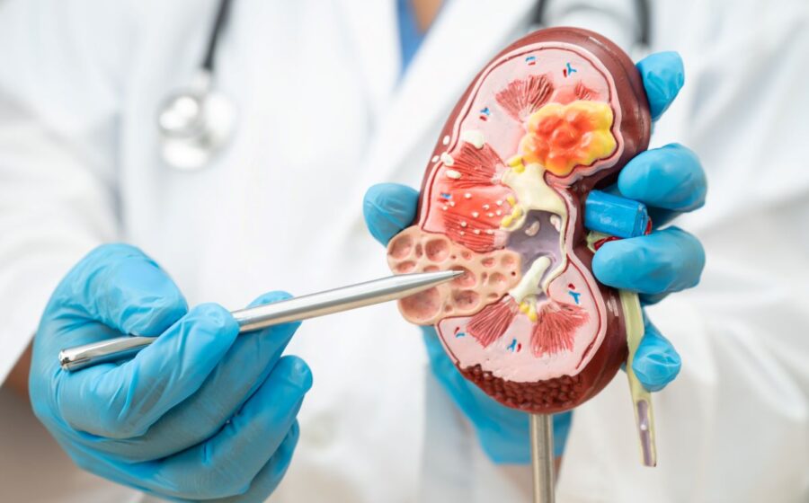 Exame PET/CT mostrando lesões de carcinoma renal de células claras com alta precisão diagnóstica