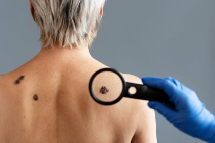 Cientista em laboratório preparando vacina de mRNA personalizada da Moderna contra melanoma