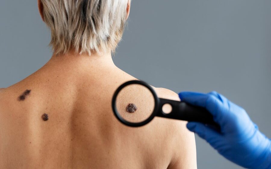 Cientista em laboratório preparando vacina de mRNA personalizada da Moderna contra melanoma